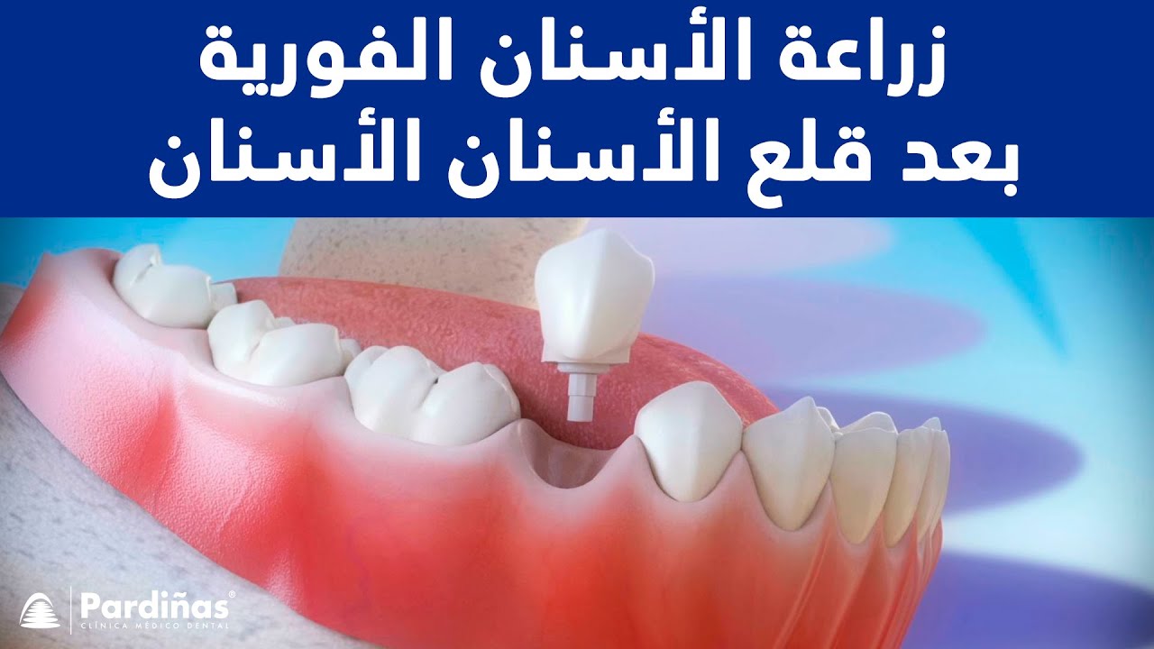 كيف يتم زراعة الاسنان، ما هى خطوات زراعه الاسنان 13364 1