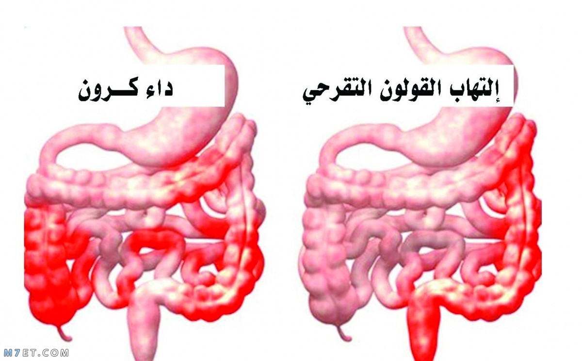 مرض كرون اسبابه وعلاجه , كل ما لا تعرفه عن داء كرون