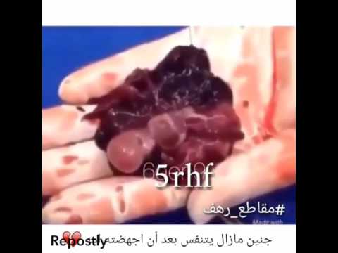 اسهل طريقة للاجهاض في البيت , طرق اجهاض منزلي