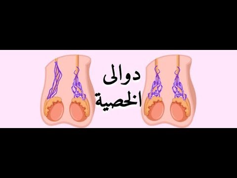 دوالي الخصية 3 ملم - تعالو نتعرف ع حاجات مهمه جدا تخص الدوالى 8062 1