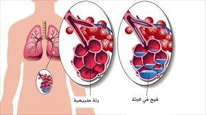 علاج مرض السل , اعشاب لعلاج السل