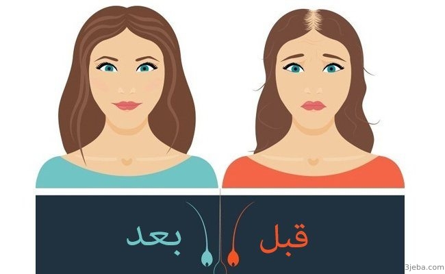 تجربتي مع الميزوثيرابي للشعر - فوائد واضرار علاج الشعر بحقن الميزوثيرابي 7889 1